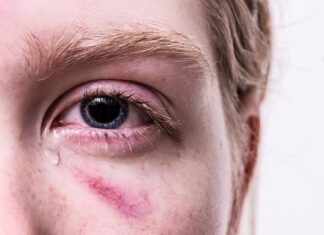 Dlaczego robi się siniaki po pobraniu krwi?